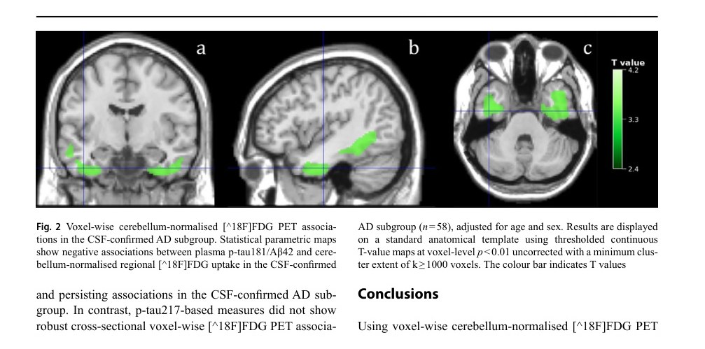 Mappa voxel-wise nel sottogruppo Alzheimer confermato da CSF