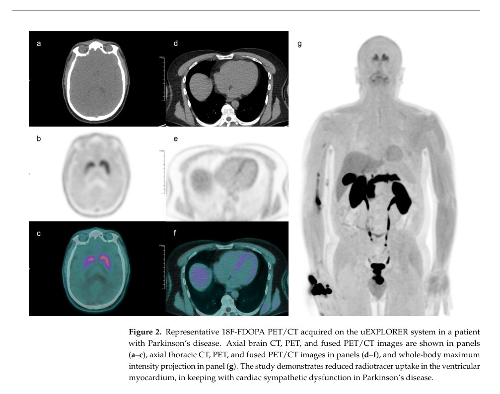 Immagini PET/CT con 18F-FDOPA e coinvolgimento cardiaco